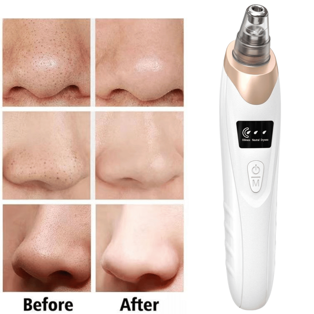 Electric Blackhead Remover – Deep Pore Cleaning Device