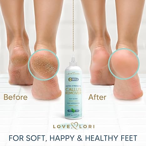 Callus Remover for Feet (Extra Strength) Foot Callus Remover Gel