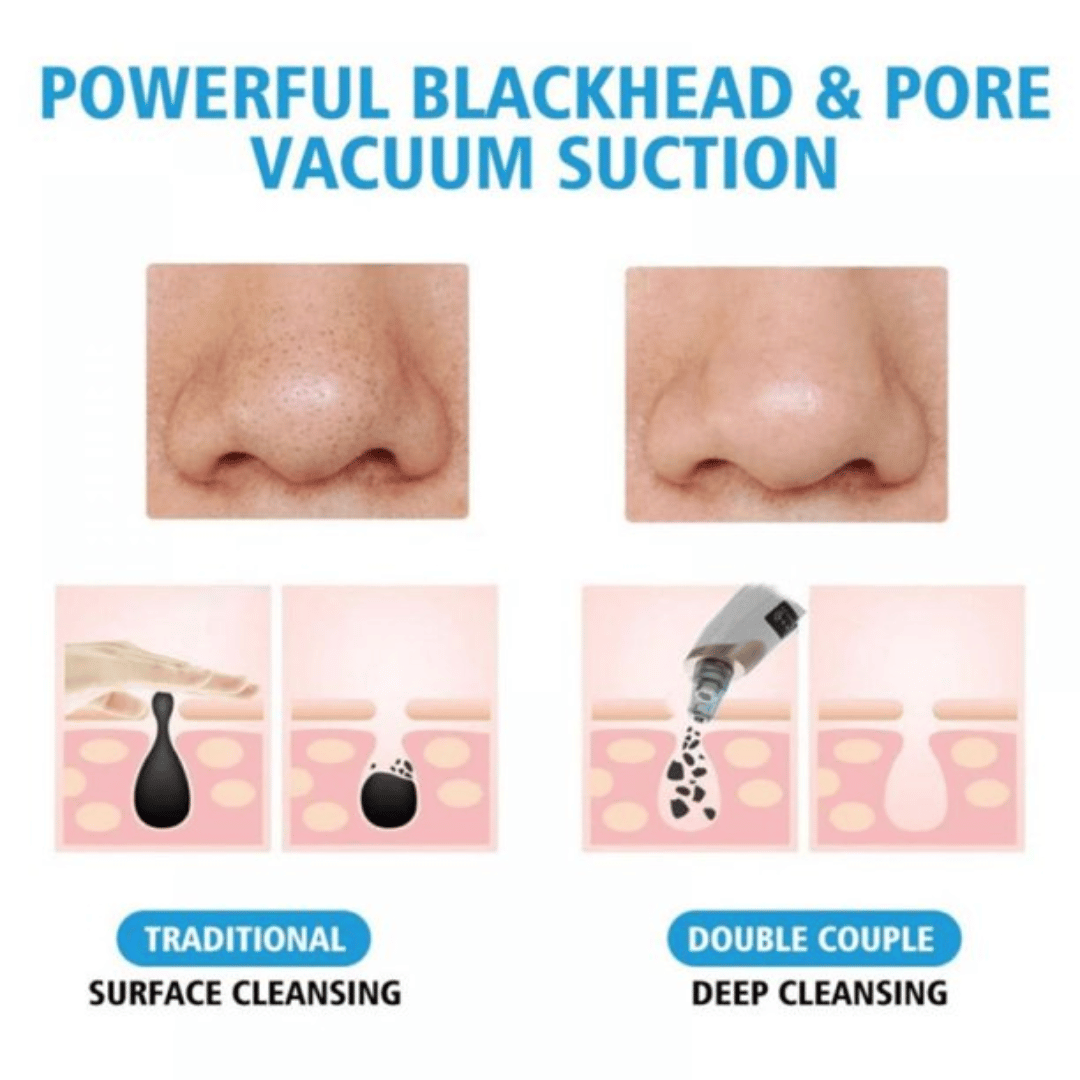 Electric Blackhead Remover – Deep Pore Cleaning Device